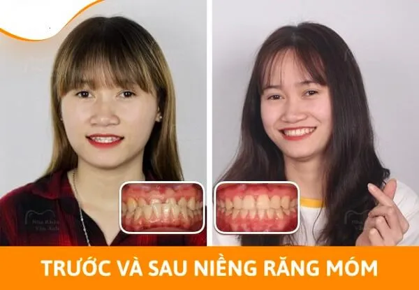 Trước và sau khi niềng răng móm