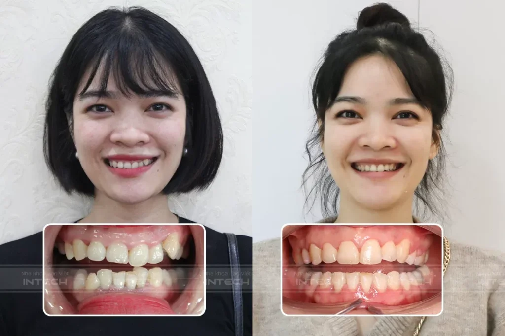 Trước và sau khi niềng răng trường hợp khớp cắn sâu