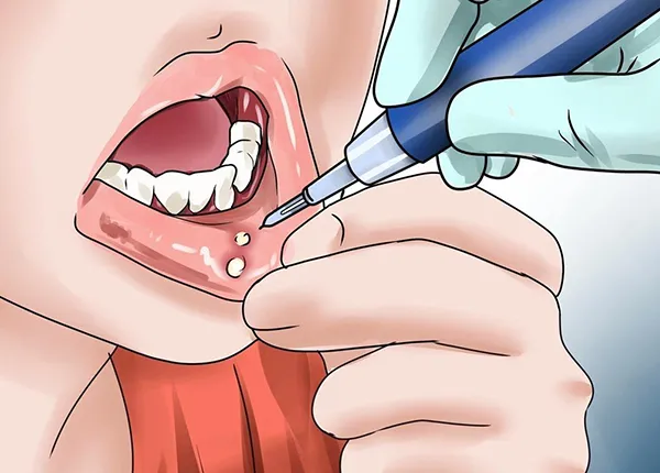 Bị nổi đẹn trong miệng làm sao hết