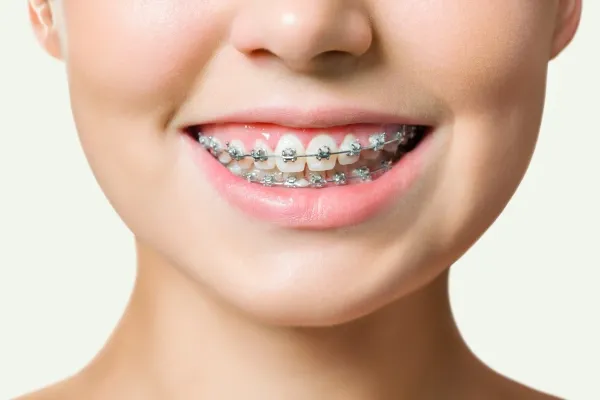 Cách điều trị răng khấp khểnh