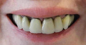 Cách phòng tránh tình trạng răng đen