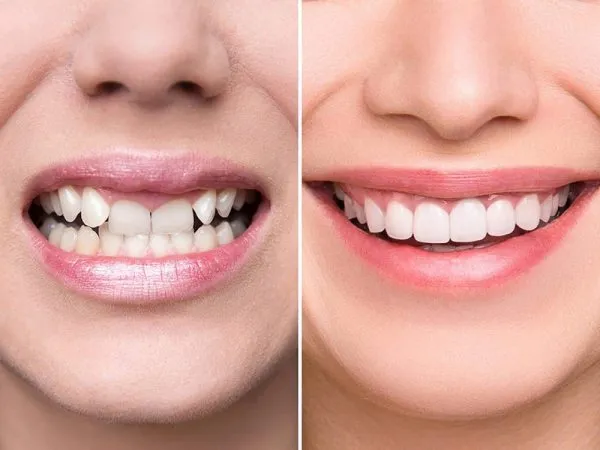 Răng lòi xỉ phải làm sao? Nguyên nhân và cách điều trị 8 Điều trị răng bị lòi xỉ bằng cách nào tốt nhất