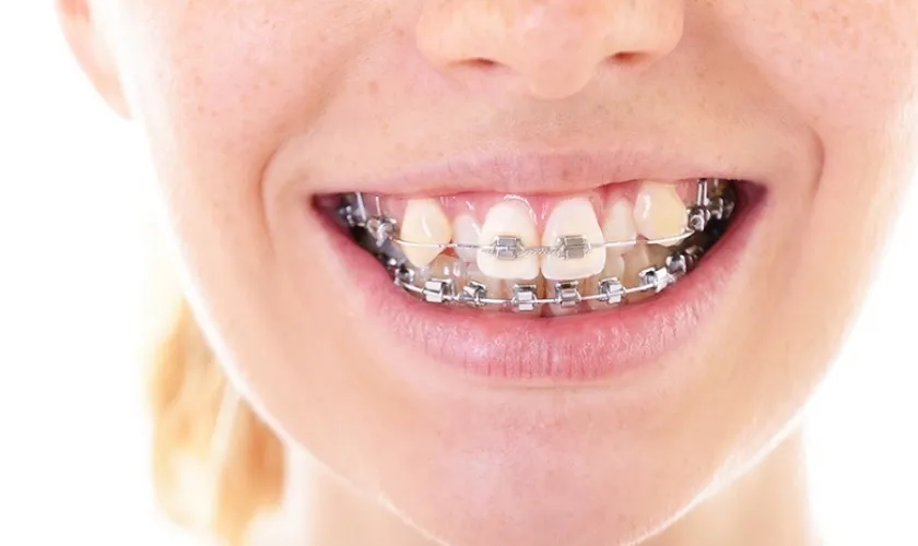 Điều trị răng khấp khểnh mất bao lâu