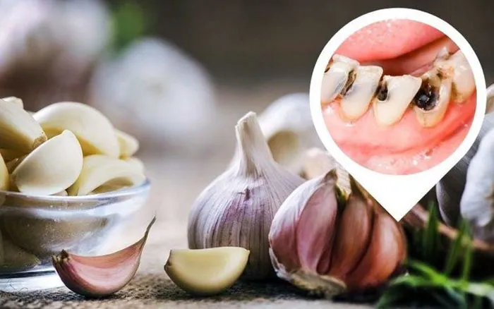 15 cách chữa đau răng sâu nhanh nhất tại nhà 8 Dùng tỏi trị đau răng