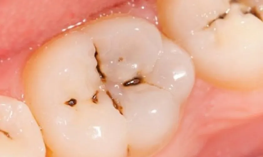 Hậu quả khi răng bị đen trên bề mặt