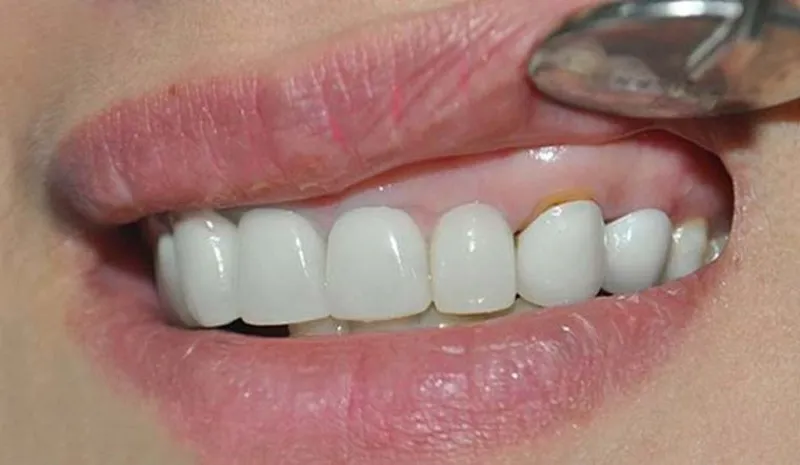 Khắc phục tình trạng răng đen
