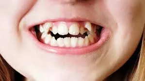 Nguyên nhân làm răng khấp khểnh