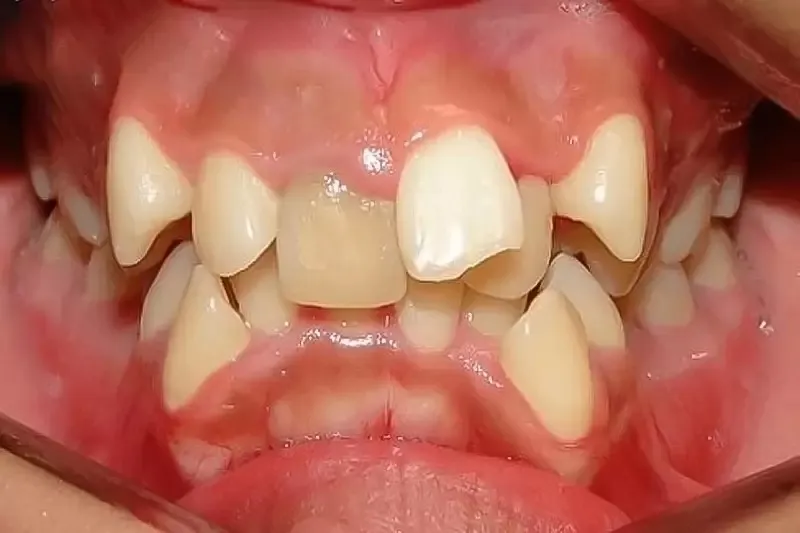 Răng lòi xỉ phải làm sao? Nguyên nhân và cách điều trị 6 Răng bị lòi xỉ có nguy hiểm không