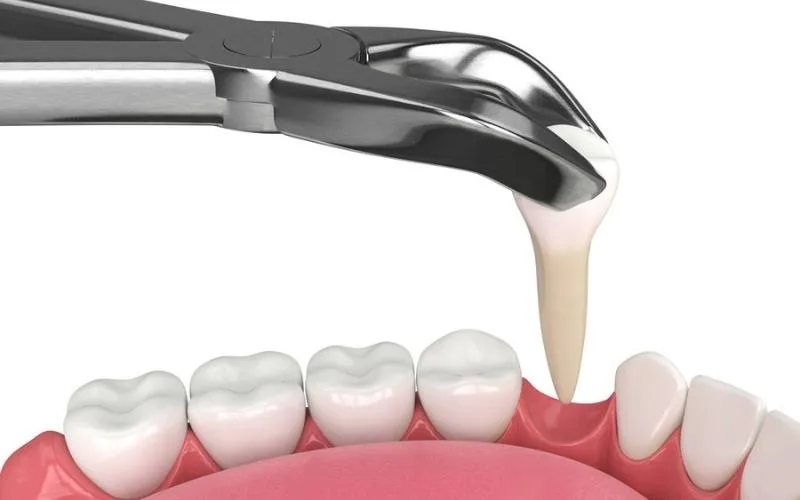 Răng lòi xỉ phải làm sao? Nguyên nhân và cách điều trị 7 Răng bị lòi xỉ có nhổ được không
