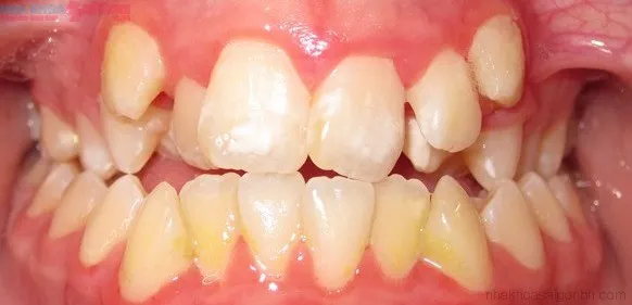 Răng khấp khểnh phải làm sao? Nguyên nhân và cách xử lý