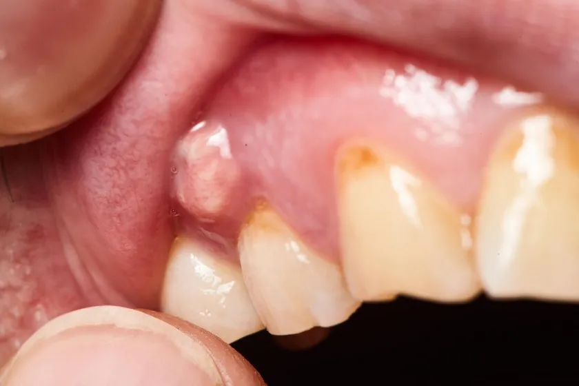 Sưng lợi hàm trên là gì? Nguyên nhân và cách điều trị 5 Sưng lợi hàm trên có thể là dấu hiệu của bệnh lý gì