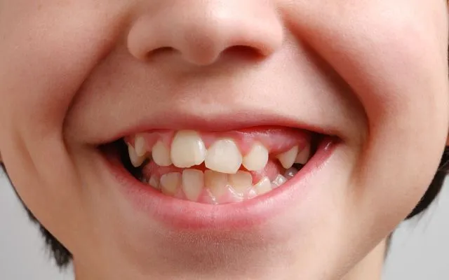 Răng lòi xỉ phải làm sao? Nguyên nhân và cách điều trị