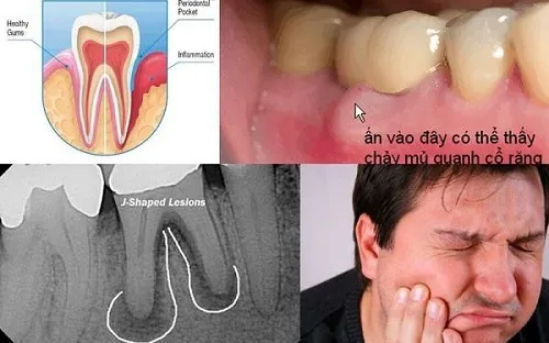 Áp xe răng có lan ra các vùng xung quanh không
