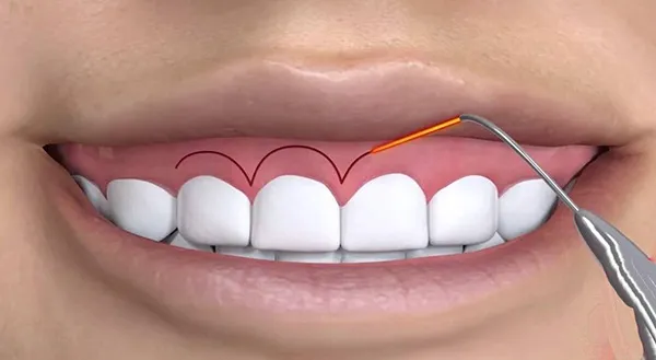 Bệnh nhân cần làm gì sau phẫu thuật cười hở lợi