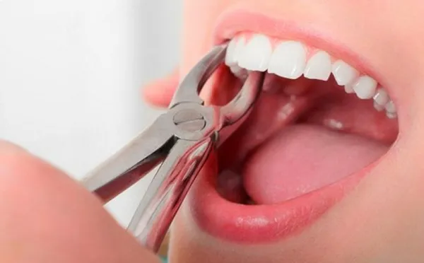 Các lựa chọn điều trị áp xe răng là gì