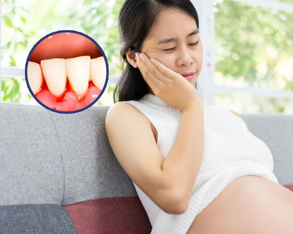 Cách chăm sóc răng miệng khi bầu bị chảy máu chân răng