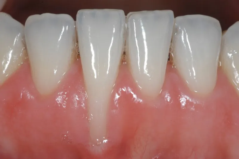 Cách phòng tránh tụt lợi hở chân răng