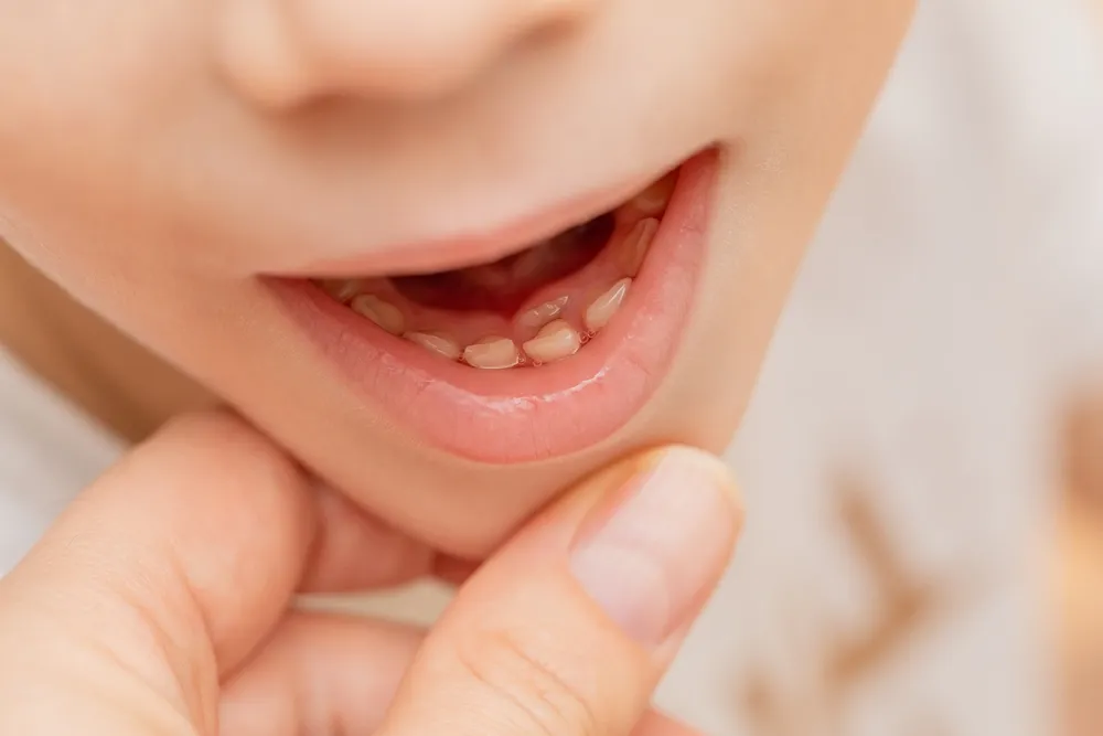 Cần làm gì khi răng sữa không rụng