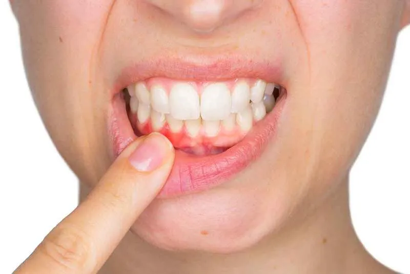Chăm sóc răng miệng đúng cách để phòng ngừa tụt nướu