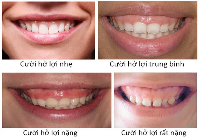 Cười hở lợi là gì? Cách khắc phục tình trạng này hiệu quả