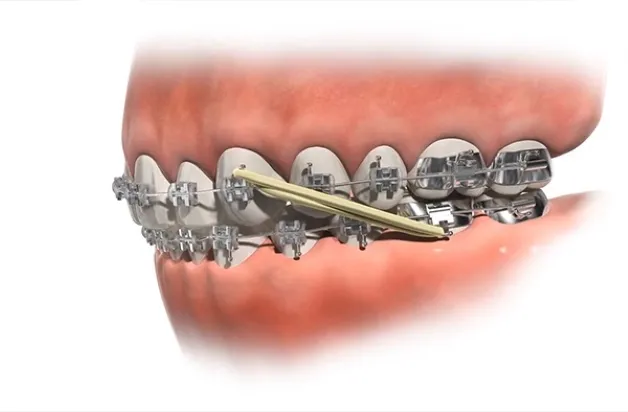 Đeo thun liên hàm có đau không