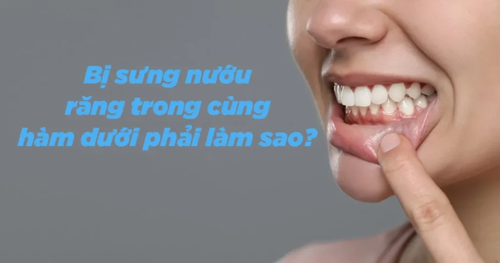 Điều trị sưng nướu răng trong cùng hàm dưới
