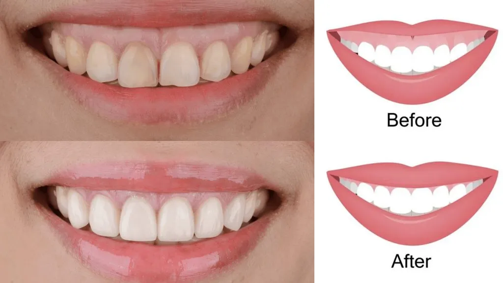 Một số phương pháp giúp cải thiện nụ cười hở lợi