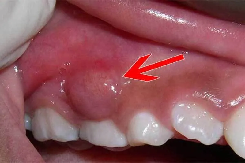 Hướng dẫn 7 cách trị áp xe răng tại nhà đơn giản, hiệu quả 8 Nguyên Nhân Gây Áp Xe Răng