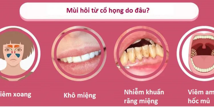 Nguyên Nhân Gây Hôi Miệng Từ Cổ Họng