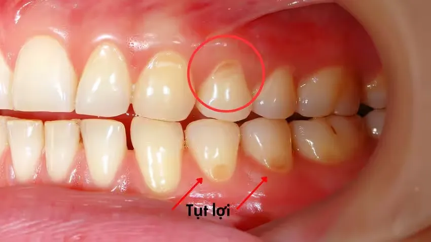 Nguyên nhân của tình trạng tụt lợi hở chân răng