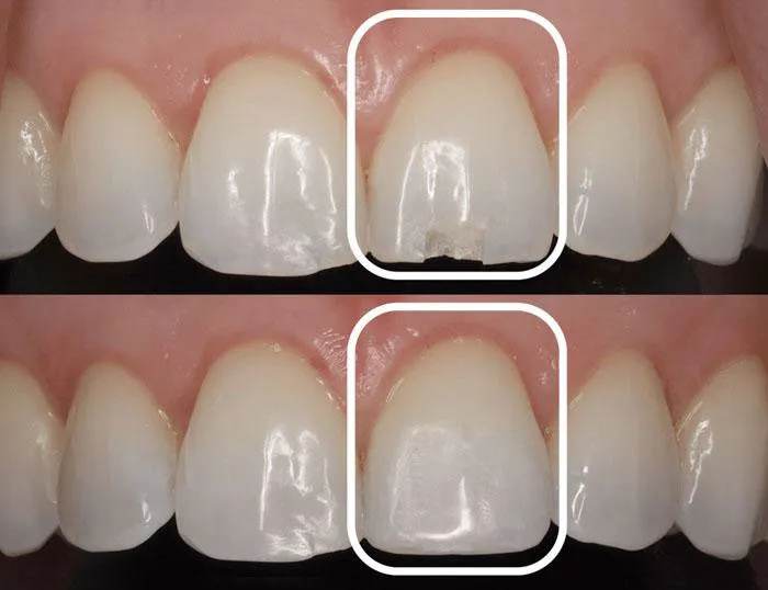 Phương pháp điều trị răng cửa bị nứt nhẹ