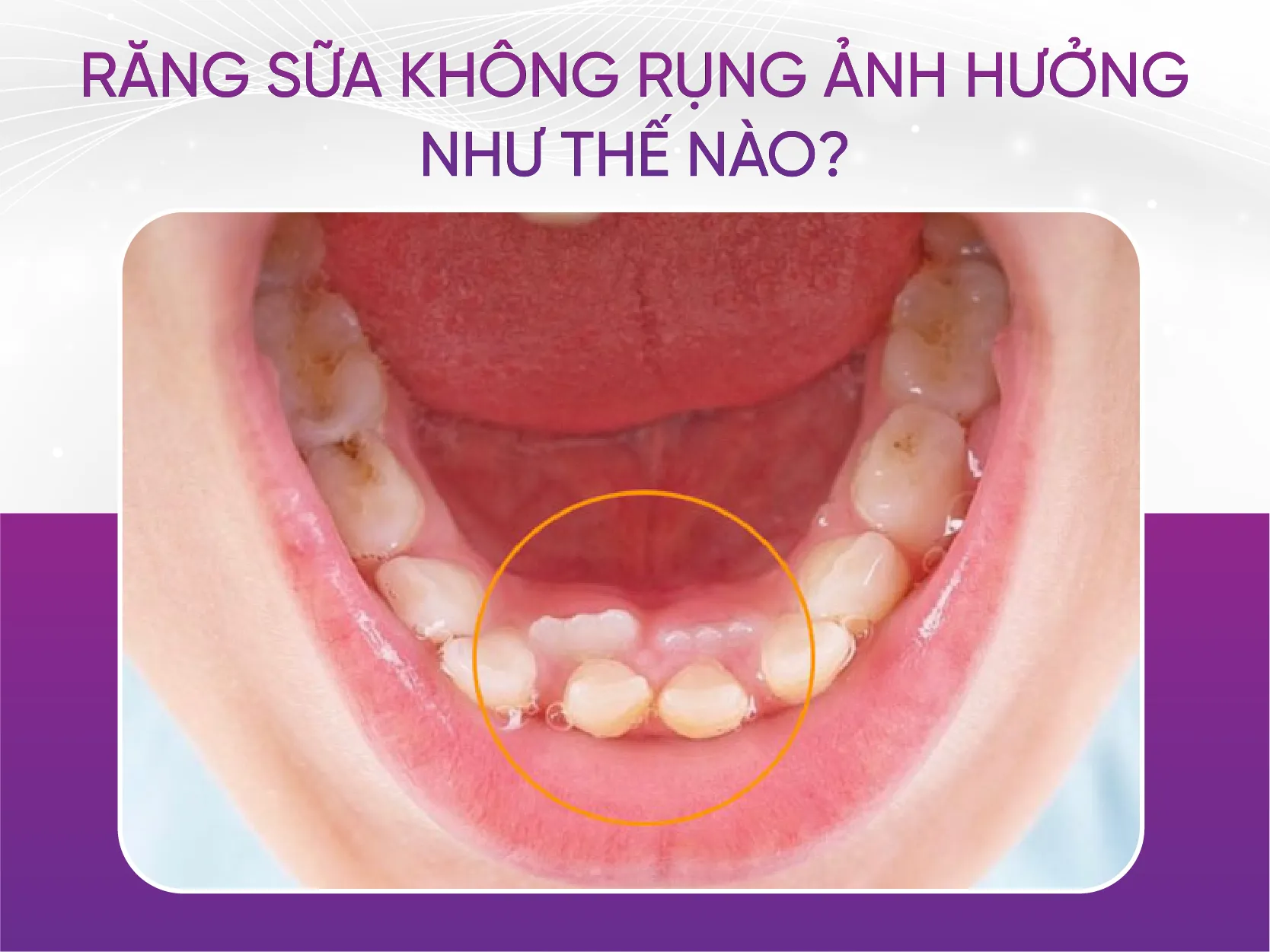 Răng sữa không rụng có ảnh hưởng gì