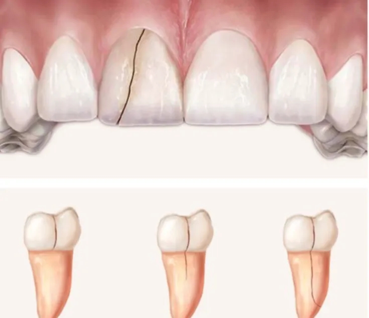 Triệu chứng nhận biết răng cửa bị nứt nhẹ