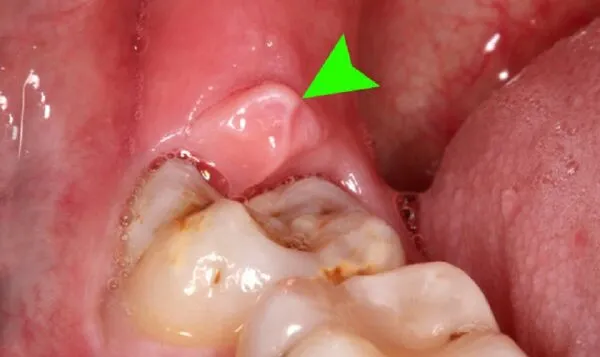 Triệu chứng sưng nướu răng trong cùng hàm dưới