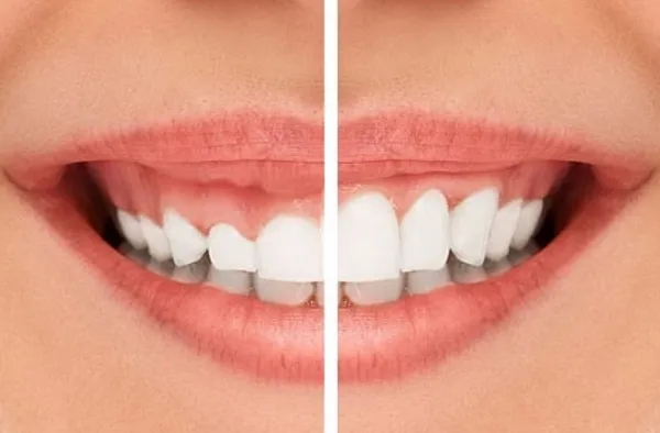 Trước khi phẫu thuật điều trị cười hở lợi cần lưu ý những gì