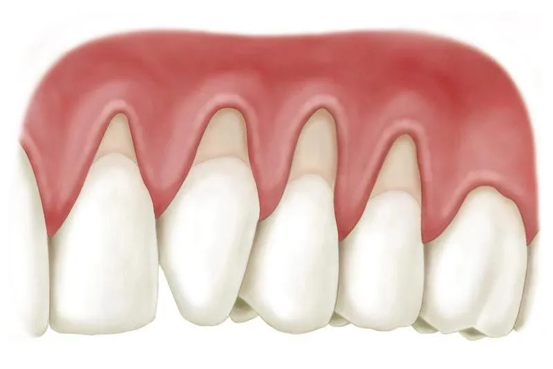cách điều trị tụt lợi hở chân răng