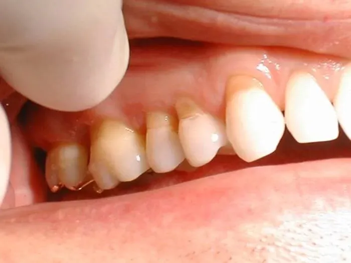tụt nướu răng