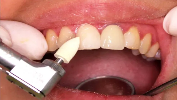 Trám răng composite là gì? Bao nhiêu tiền? Có bền không? 11 Các bước trám răng bằng composite