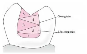 Trám răng composite là gì? Bao nhiêu tiền? Có bền không? 8 Các loại composite trong nha khoa