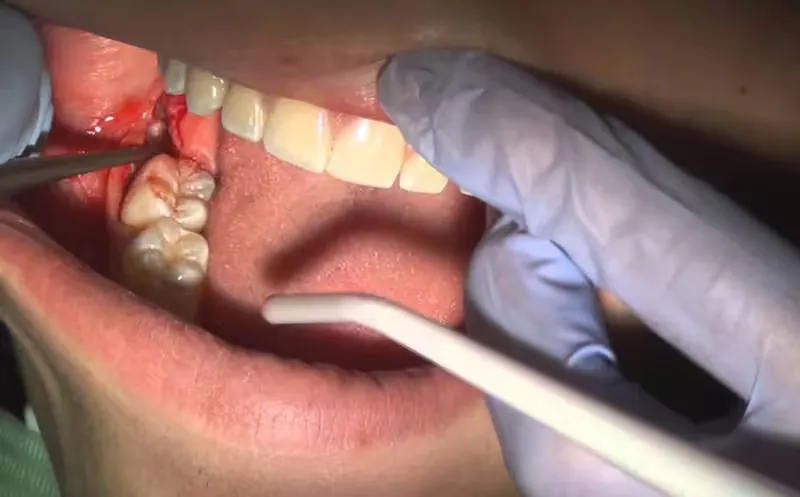 Các phương pháp điều trị áp xe răng