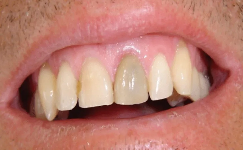 Chết tủy răng có nguy hiểm không