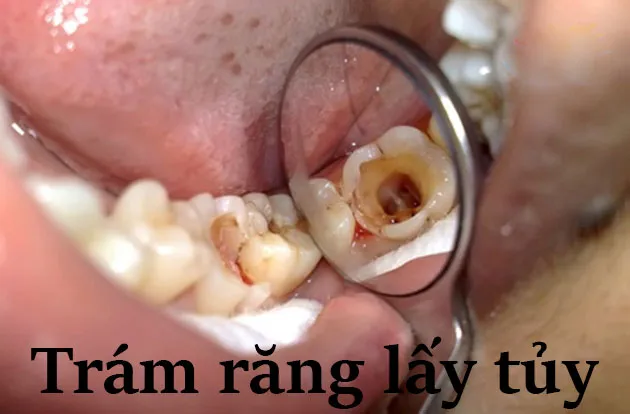 Có bắt buộc phải lấy tủy khi trám răng không