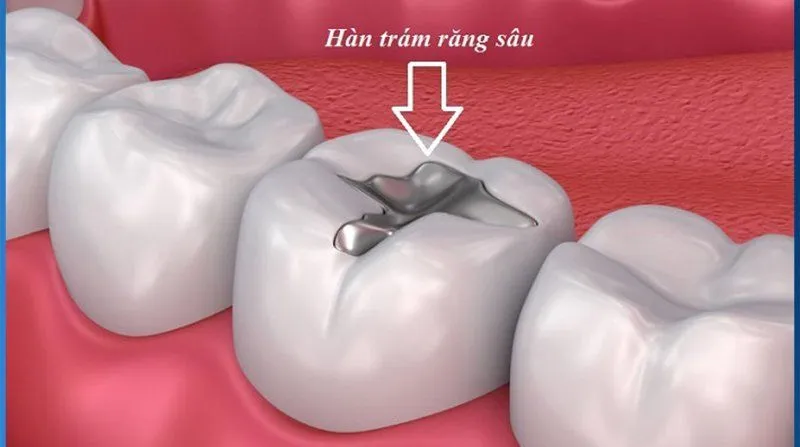 Hàn răng sâu được bao lâu