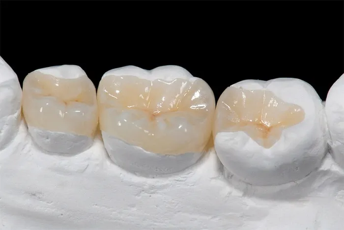 Hàn răng sâu hết bao nhiêu tiền