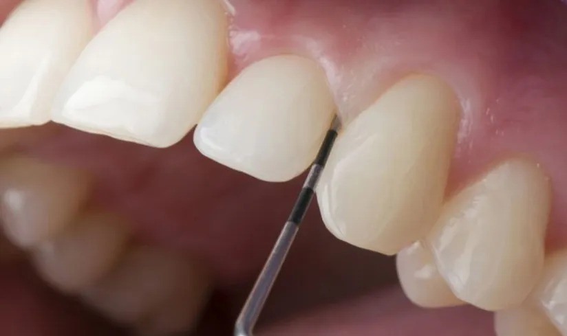 Khi nào không nên mài răng