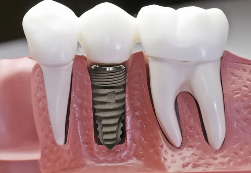 Phòng ngừa và điều trị tiêu xương răng bằng cấy ghép Implant