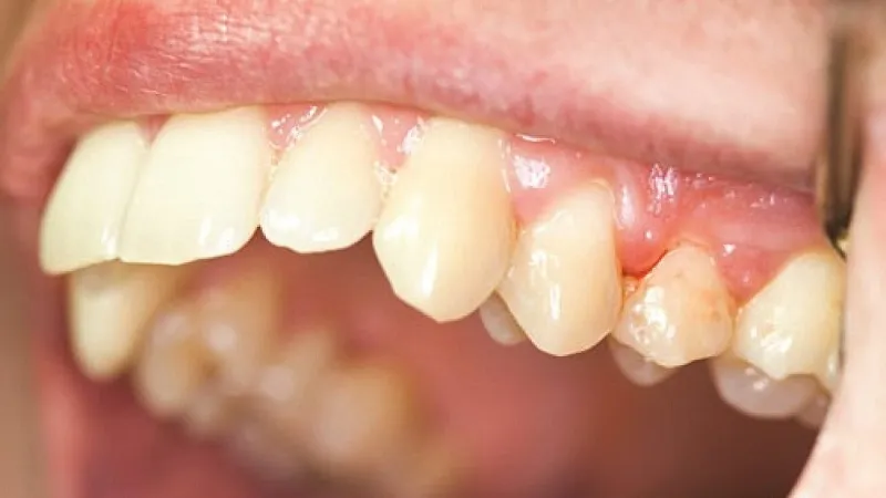 Răng bị lung lay có nên nhổ không