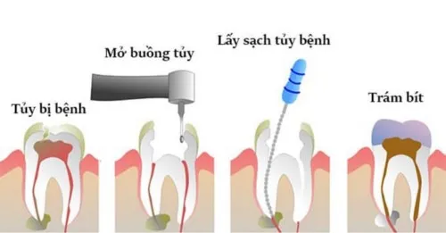 Sơ lược về trám răng lấy tủy