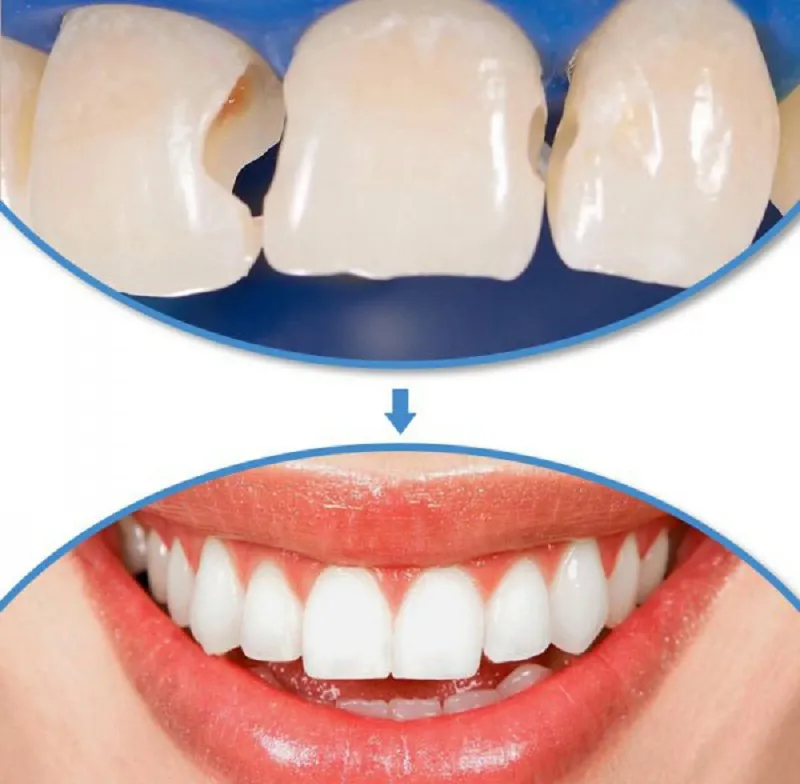 Trám răng composite là gì? Bao nhiêu tiền? Có bền không? 12 Trám răng Composite bao nhiêu tiền