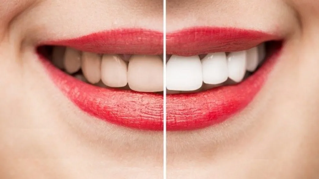 Có nên tẩy trắng răng không? Khi nào tẩy và lưu ý cần biết